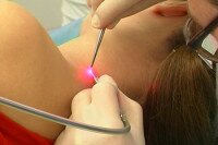 Удаление папиллом лазером – современный подход к решению проблемы новообразований на лице и теле