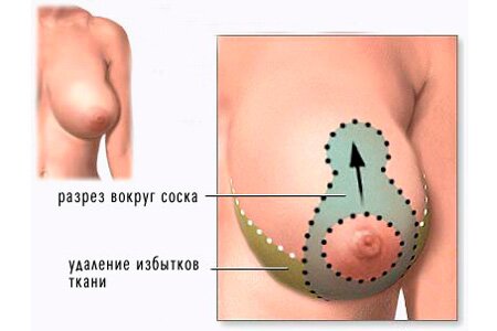 Методы хирургической подтяжки груди