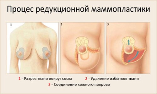 Процесс редукционной маммопластики