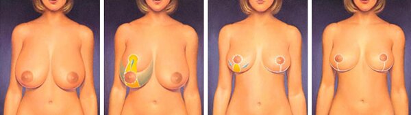 Уменьшение груди с помощью хирургической операции